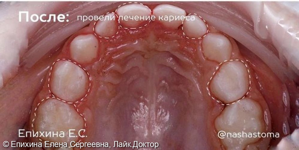 Лечение кариеса у ребенка фото 4 · Санкт-Петербург