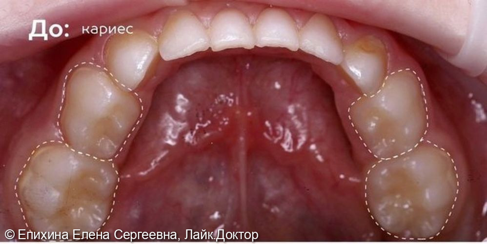 Лечение кариеса у ребенка фото 5 · Санкт-Петербург