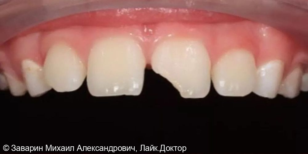 Реставрация зуба у подростка с помощью пломбы - фото №1