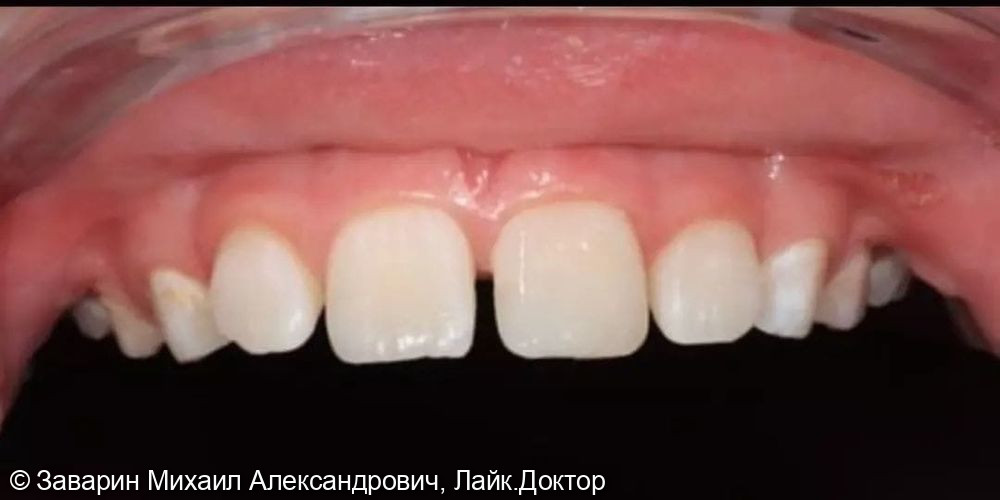 Реставрация зуба у подростка с помощью пломбы - фото №2