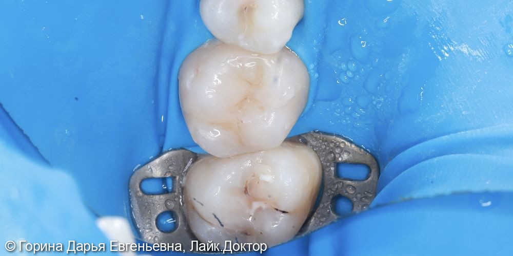 Кариес дентина 1.5, 1.7 - фото №2