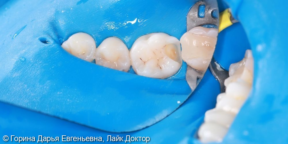 Кариес дентина 3.6 зуба фото 3 · Вологда