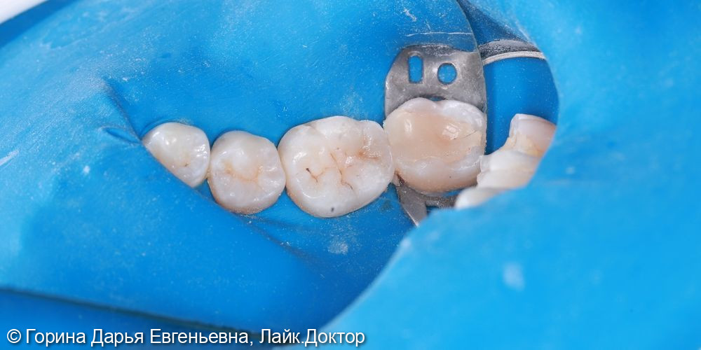Кариес дентина 3.6 зуба - фото №4