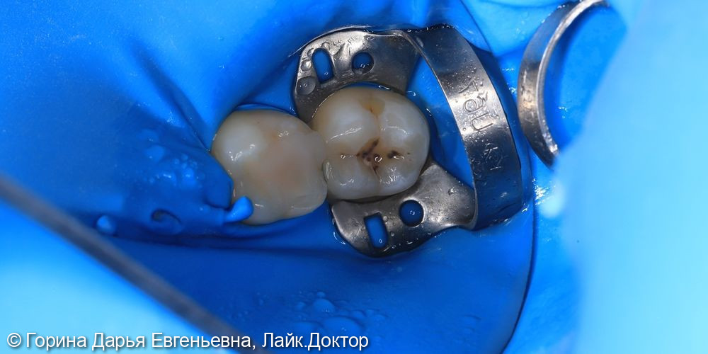 Кариес дентина 2.7 фото 2 · Вологда