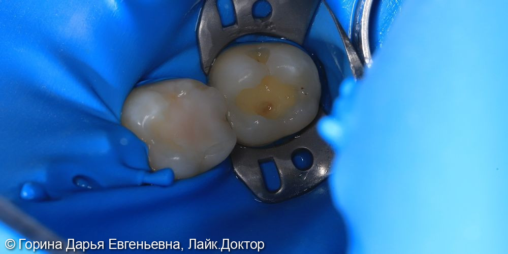 Кариес дентина 2.7 фото 3 · Вологда
