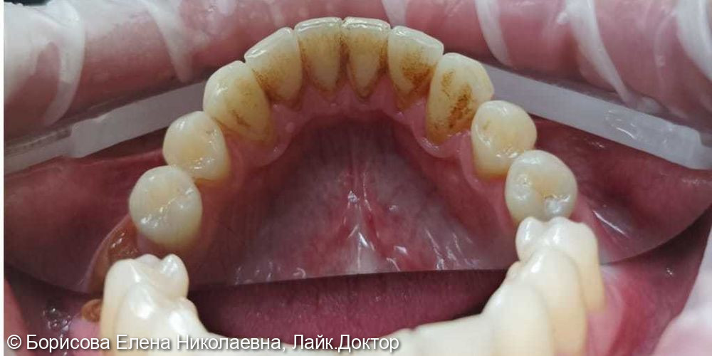 Профессиональная гигиена полости рта - фото №1