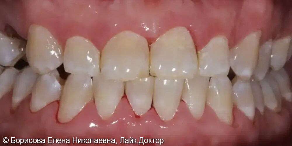 Профессиональная гигиена - фото №2