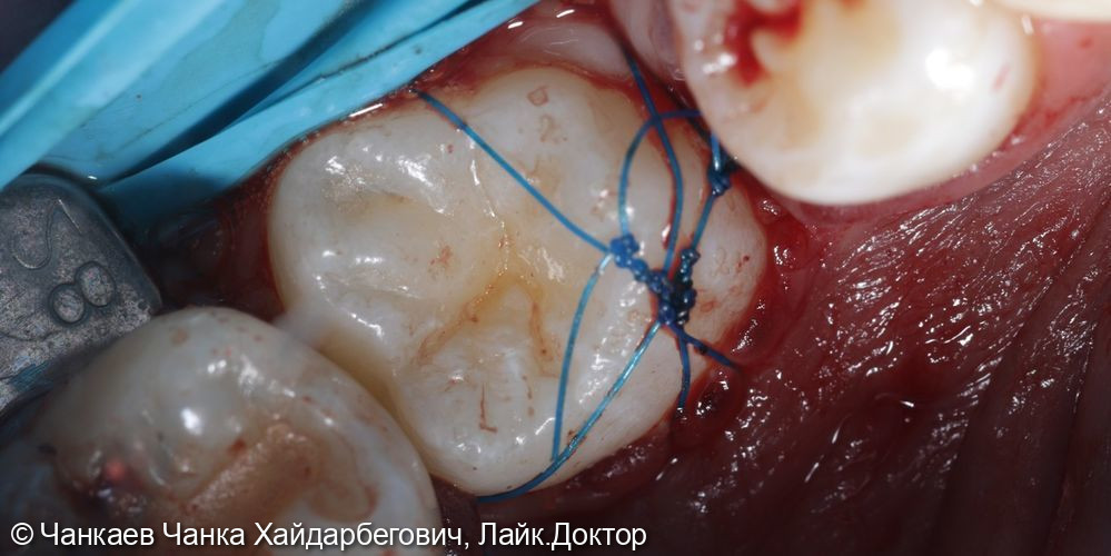 Аутотрансплантация фото 4 · Вологда