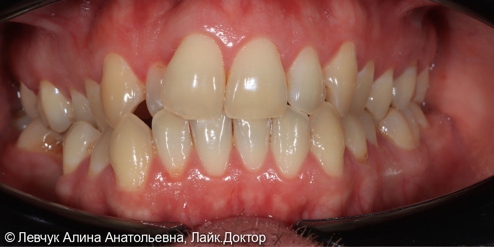 Лечение при помощи комбинированной брекет системы Damon Clear/ Q (керамика + металл) с удалением зубов мудрости на нижней челюсти; - фото №1