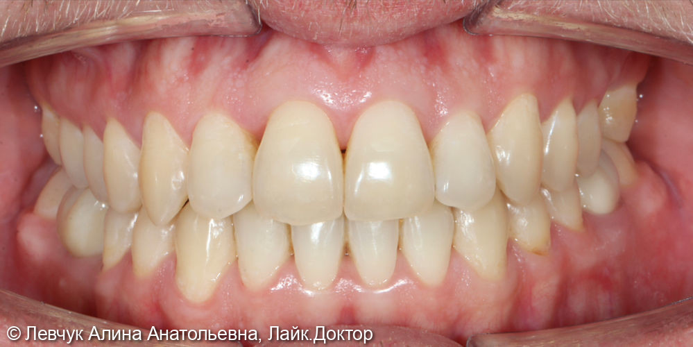 Лечение при помощи комбинированной брекет системы Damon Clear/ Q (керамика + металл) с удалением зубов мудрости на нижней челюсти; - фото №2
