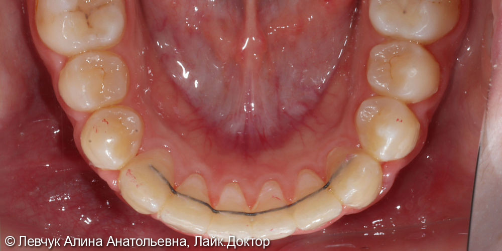 Лечение на брекет-системе - фото №4