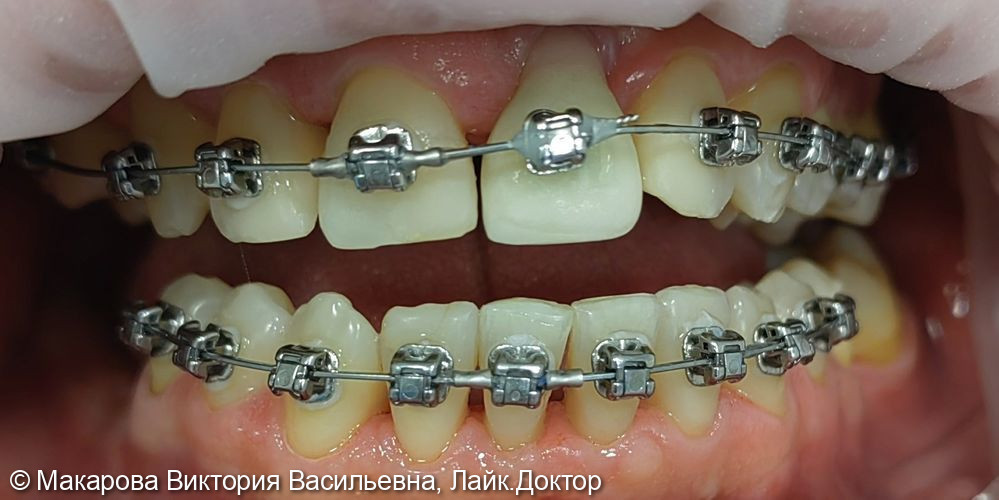 Чистка с брекет-системой - фото №1