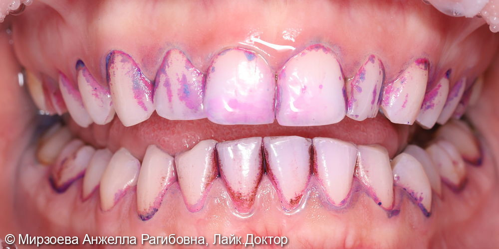 Профессиональная гигиена зубов - фото №2