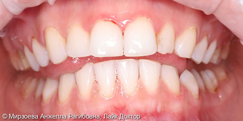 Профессиональная гигиена зубов - фото №3