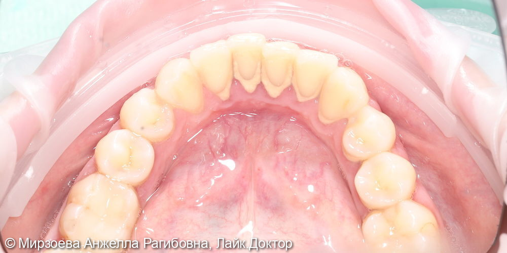 Профессиональная гигиена полости рта - фото №3