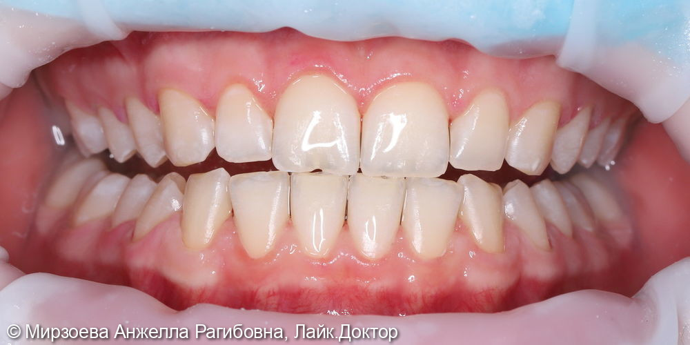 Профессиональная гигиена полости рта - фото №7