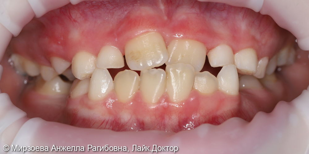 Профессиональная гигиена полости рта - фото №1