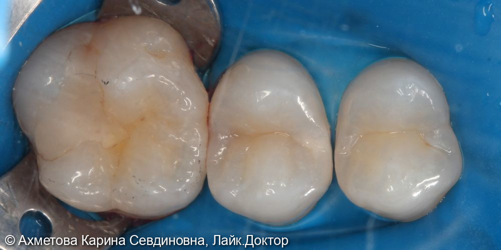 лечение кариеса 25 зуба - фото №1
