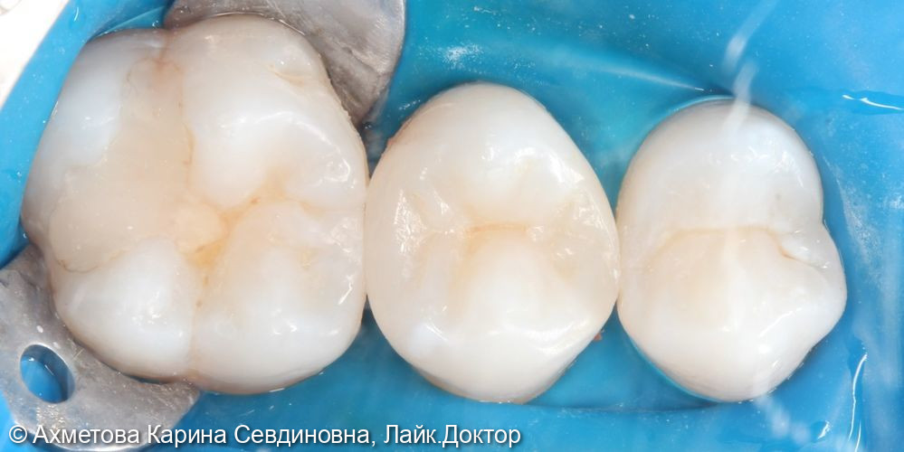 лечение кариеса 25 зуба - фото №3