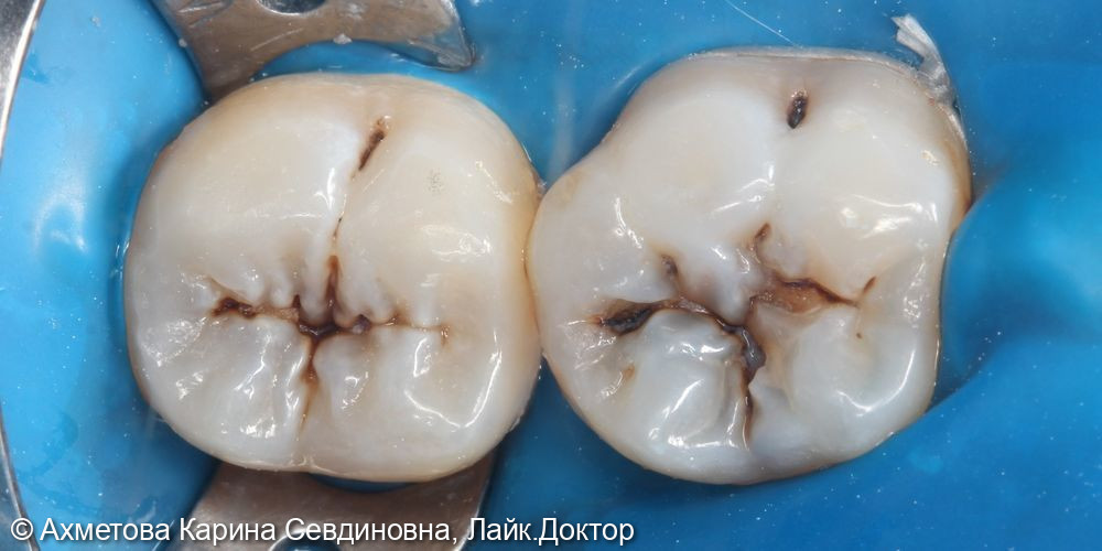 лечение кариеса 37 и 36 зуба - фото №1