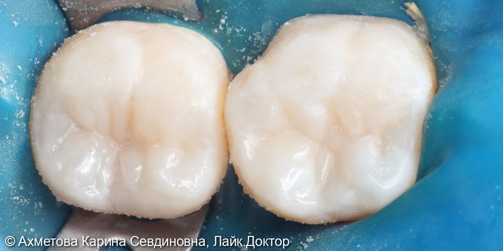 лечение кариеса 37 и 36 зуба - фото №2