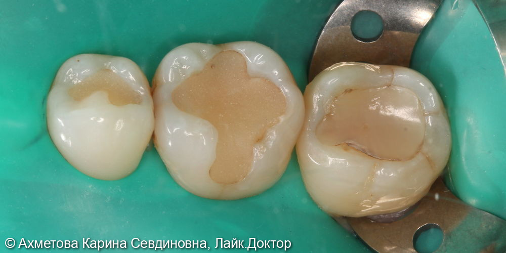 замена несостоятельных пломб у 35,36 и 37 зубов - фото №1