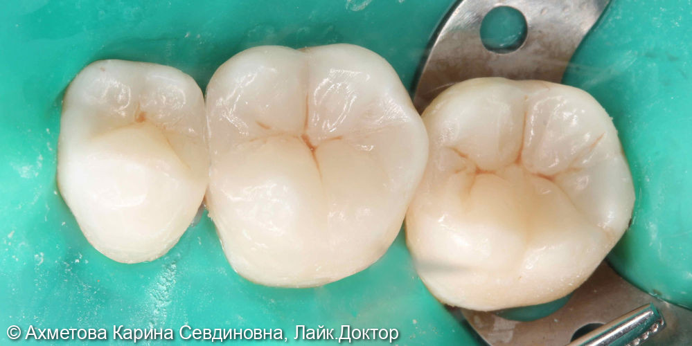 замена несостоятельных пломб у 35,36 и 37 зубов - фото №2