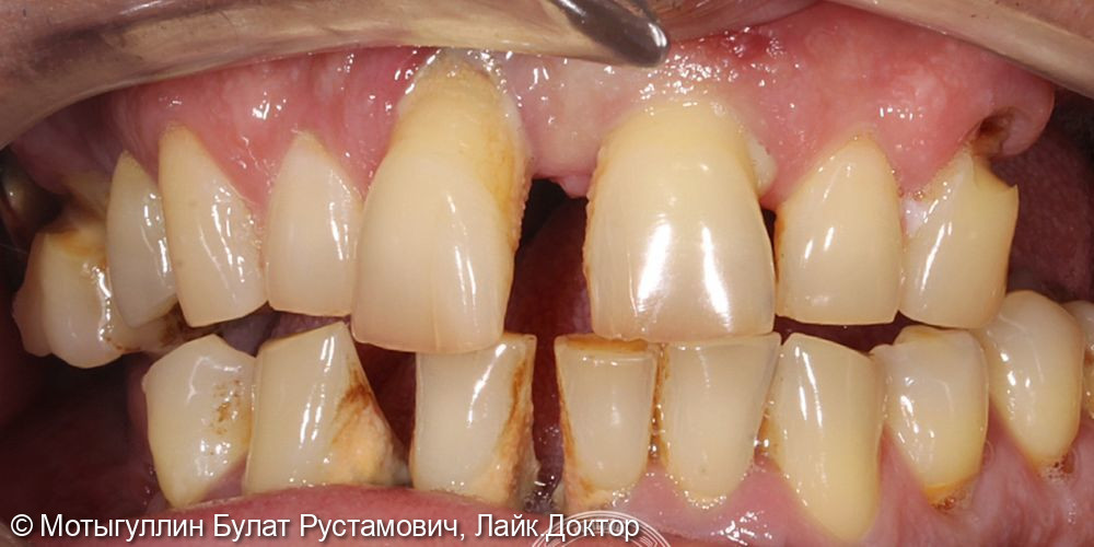 Восстановление всех зубов по методике «All-on-4» - фото №1
