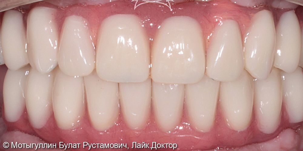 Восстановление всех зубов по методике «All-on-4» - фото №2
