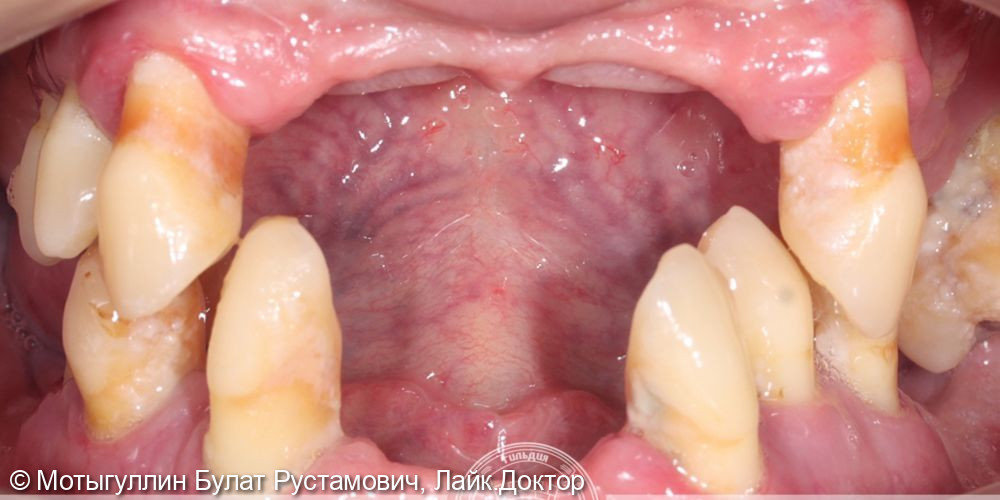 В «Гильдию стоматологов» обратилась пациентка в возрасте 41 года с жалобами на невозможность пользоваться съемным протезом, частичное отсутствие зубов, подвижность зубов, сложности в пережевывании пищи, кровоточивость десен. И, конечно,  главное - что вол - фото №1