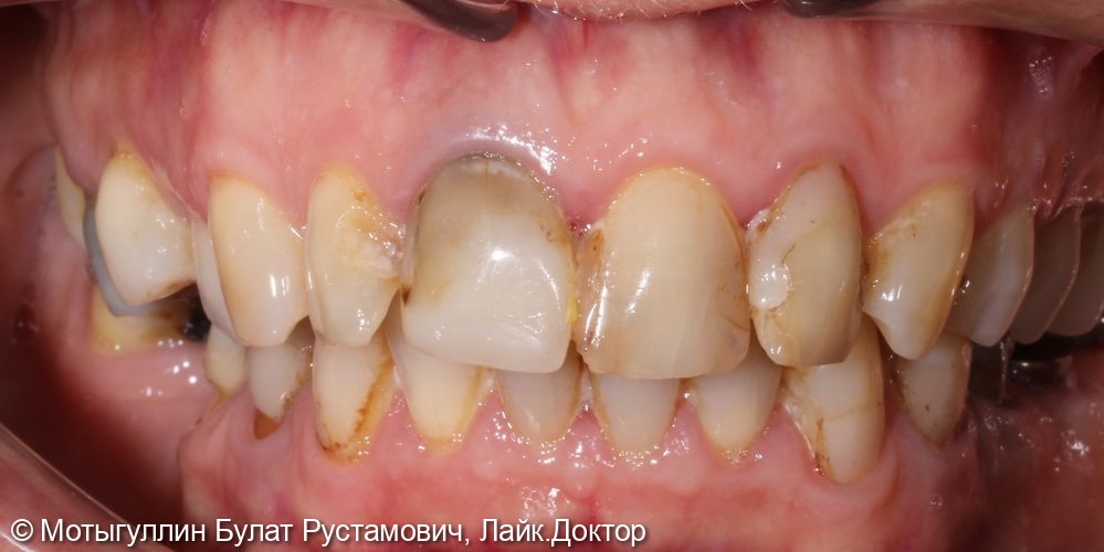 Пациентка, 60 лет, обратилась в нашу «Гильдию стоматологов» для продолжения лечения, начатого в другой клинике - фото №1