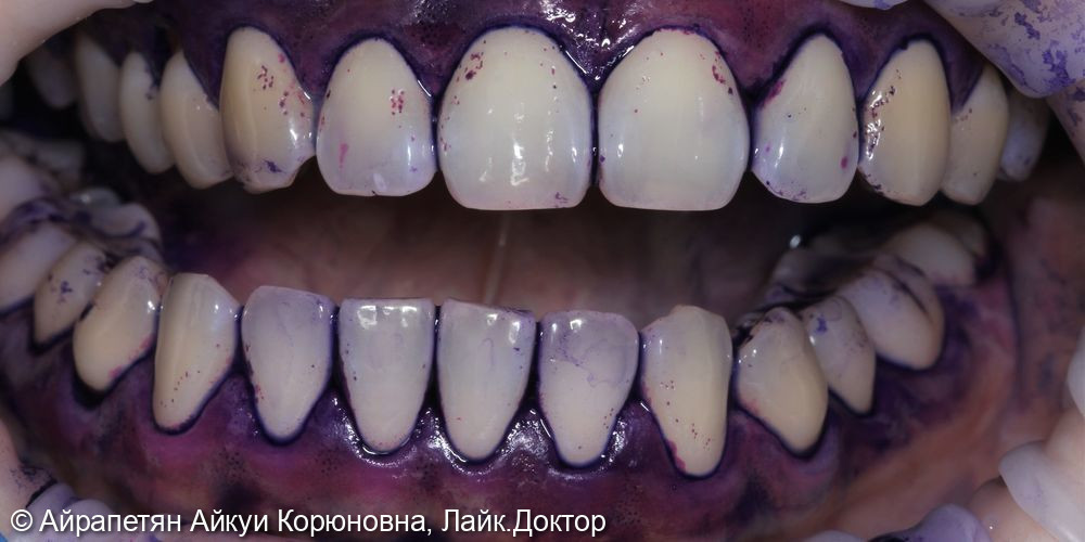 Комплексная профессиональная гигиена полости рта по швейцарскому протоколу GBT - фото №1