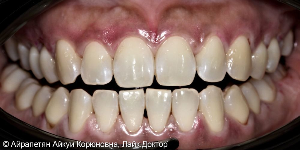 Комплексная профессиональная гигиена полости рта по швейцарскому протоколу GBT - фото №2
