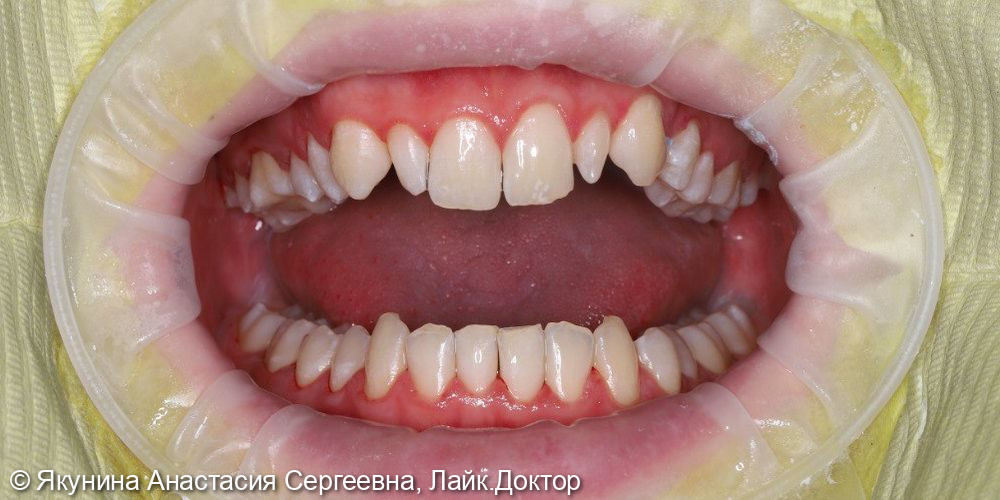 Профессиональная гигиена полости рта - фото №3