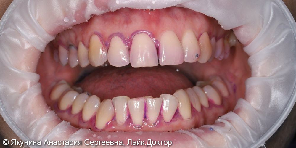 Профессиональная гигиена полости рта - фото №2