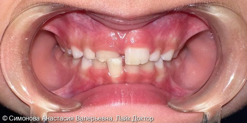 Коррекция обратного резцового перекрытия в области центральных резцов верхнего и нижнего зубных рядов - фото №1