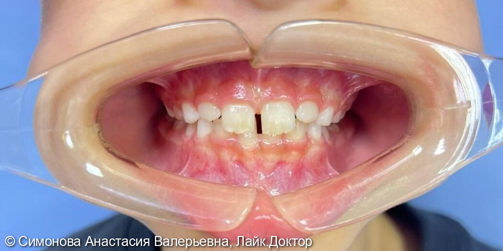 Коррекция обратного резцового перекрытия в области центральных резцов верхнего и нижнего зубных рядов - фото №2