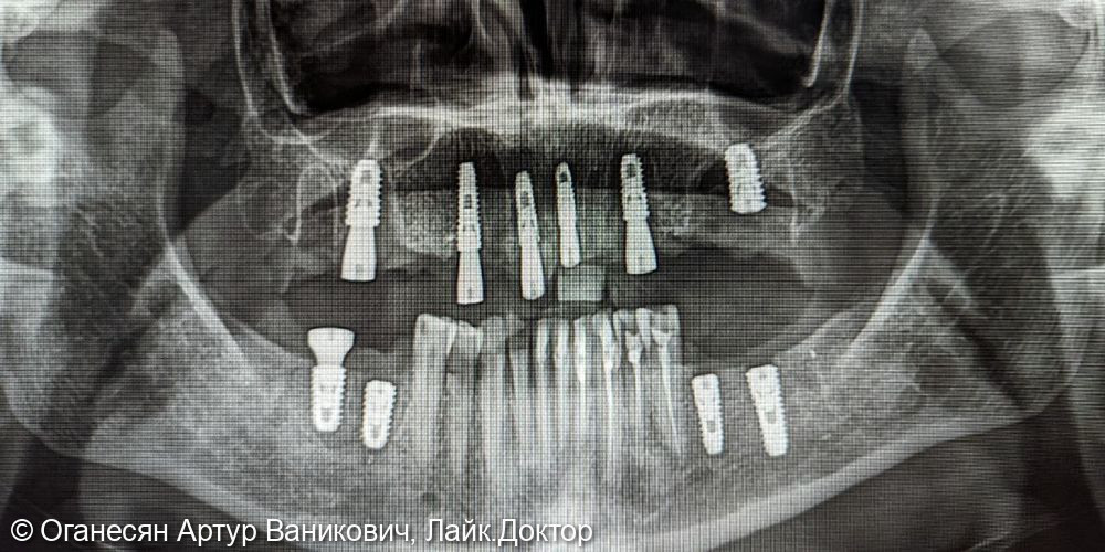 Имплантация с одномоментной нагрузкой временными коронками - фото №2