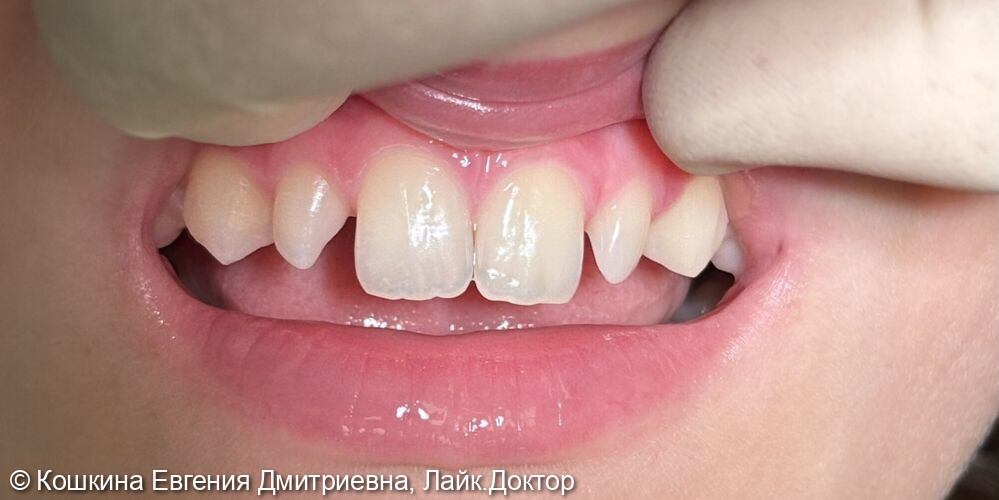 Измененная форма зубов 1.2 и 2.2 ( «шиловидные» зубы) и наличие трем - фото №1
