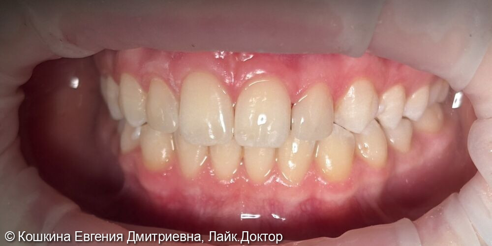 Измененная форма зубов 1.2 и 2.2 ( «шиловидные» зубы) и наличие трем - фото №2
