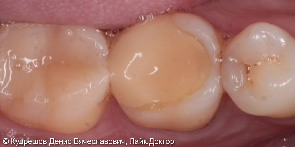 Восстановление жевательных зубов керамическими коронками E-max - фото №1