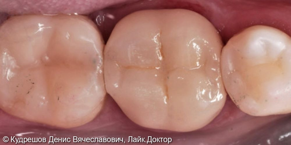 Восстановление жевательных зубов керамическими коронками E-max - фото №2