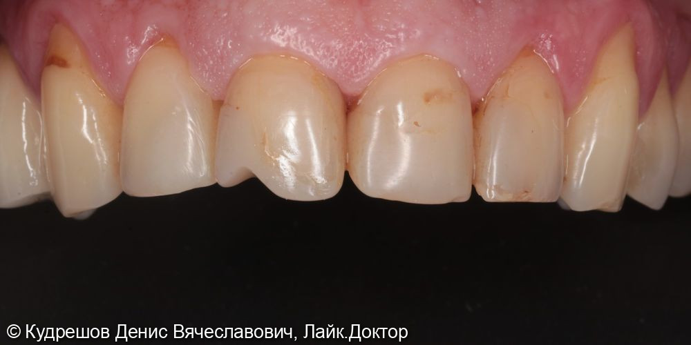 Эстетическая реставрация фронтальных зубов Emax - фото №1