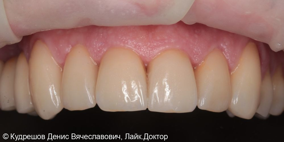 Эстетическая реставрация фронтальных зубов Emax - фото №2