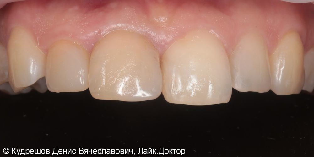 Эстетическая реставрация 12 11 21 22 зубов Emax - фото №1