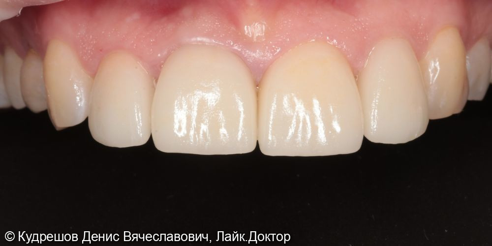 Эстетическая реставрация 12 11 21 22 зубов Emax - фото №2