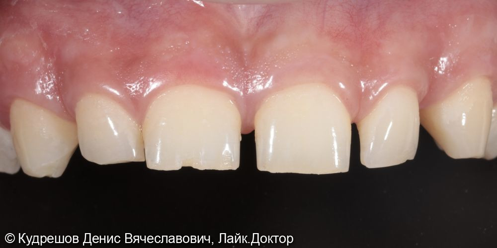 Эстетическая реставрация фронтальных зубов керамическими винирами Emax - фото №1