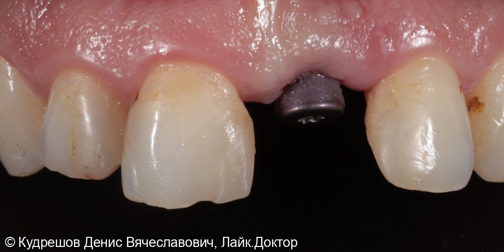 Протезирование импланта и зубов коронками из оксида циркония - фото №1