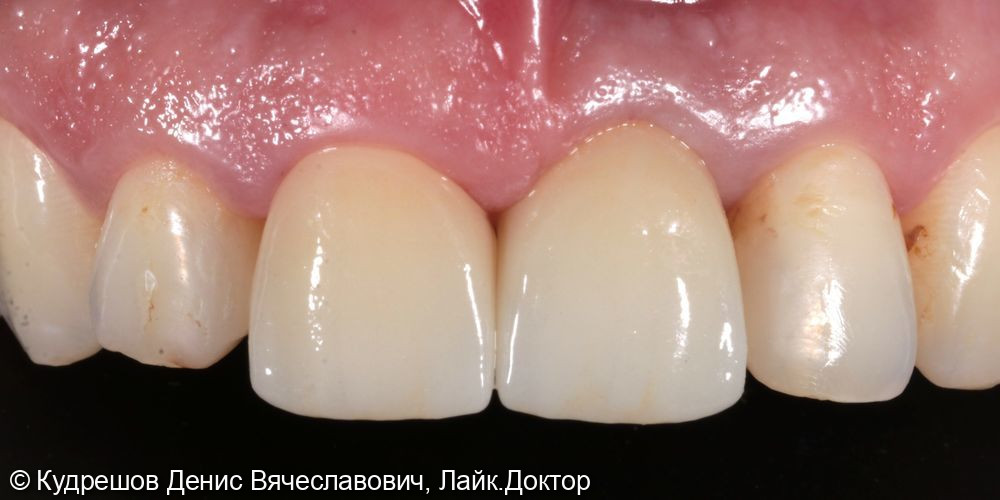 Протезирование импланта и зубов коронками из оксида циркония - фото №2