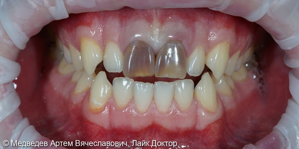 Виниры на фронтальные зубы - фото №1